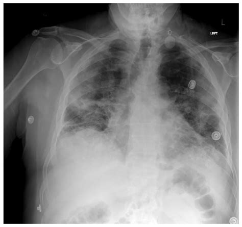 Chest X Ray Illustrating Diffuse Infiltrates In All Lung Fields With