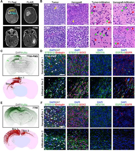 Figure 5 From A Patient Derived Glioblastoma Organoid Model And Biobank