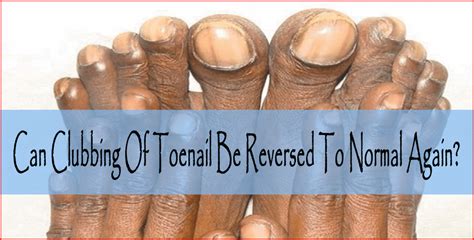 Can Clubbing Of Toenail Be Reversed To Normal Again? | Toe nails, Clubbing nails, Nail fungus ...