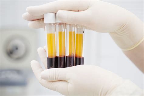 Platelet Rich Plasma Prp Treatments For Knee Osteoarthritis San