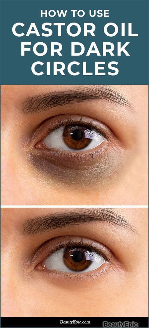 How To Use Castor Oil For Dark Circles Dark Eye Circles Dark