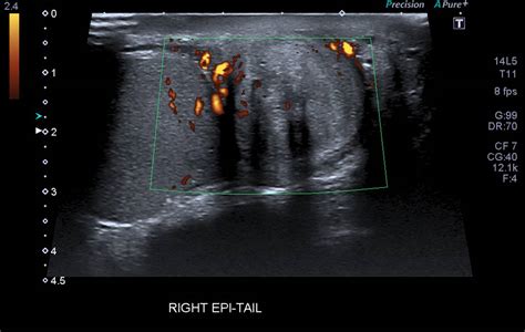 Adenomatoid Tumor Of The Epididymis Image