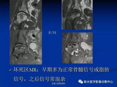 股骨头缺血坏死的影像学诊断