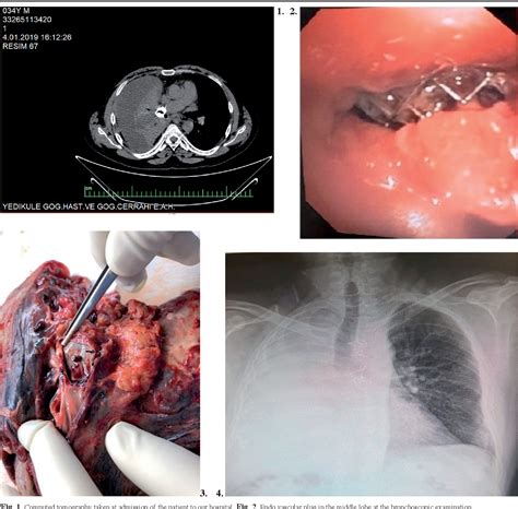 Figure From Endovascular Embolisation With Amplatzer Vascular Plug Of