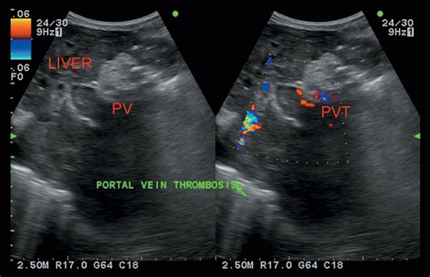 Doppler In Portal Hypertension Radiology Key