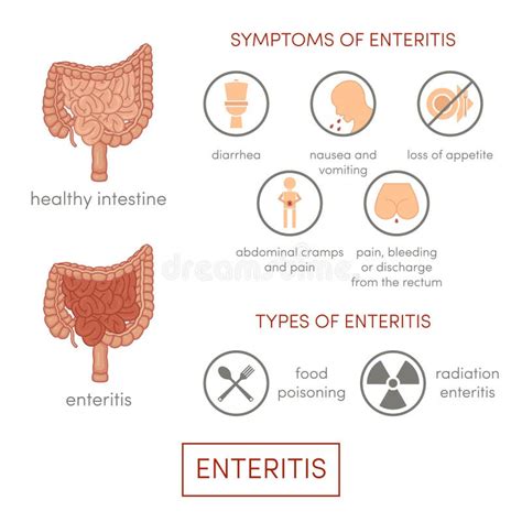 Symptomps De La Enteritis Stock De Ilustración Ilustración De Colitis