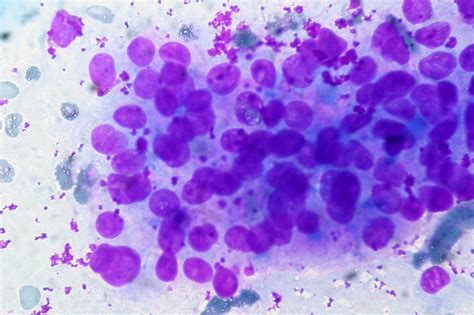 Papillary Thyroid Carcinoma Fna Giemsa Stain Ed Uthman Flickr