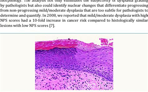 Photomicrograph Of An Orthokeratotic Lesion Without Dysplasia Oknd