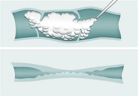 Injection Foam Sclerotherapy For Varicose Veins London Uk