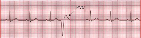 Trigeminal Premature Ventricular Contractions