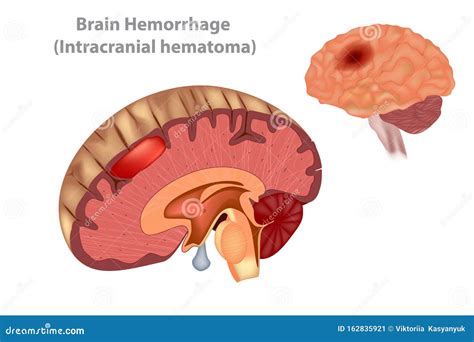 Brain Hemorrhage Intracranial Hematoma Stock Vector Illustration Of