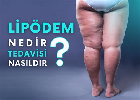 Lipödem Nedir Belirtileri ve Tedavisi Nasıldır Turan Turan