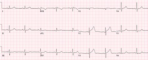 emDOCs.net – Emergency Medicine EducationEM Cases - Missed Ischemia – Never Trust the ECG ...