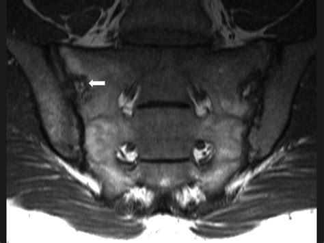 Development And Preliminary Validation Of The Spondyloarthritis