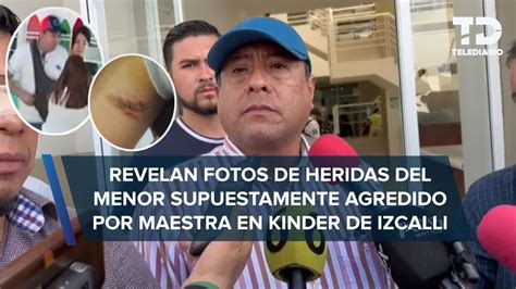 Fotos De Las Heridas Del Alumno Del K Nder De Cuautitl N Izcalli Son