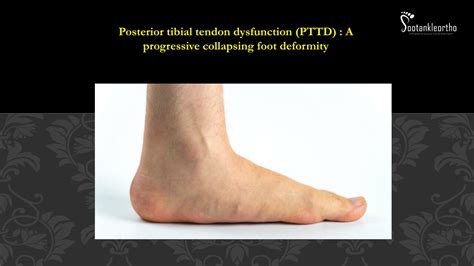 Ppt Posterior Tibial Tendon Dysfunction Pttd Footankleortho