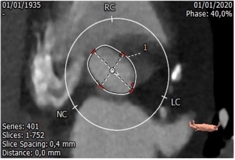 CT Scan Measurements Of The Aortic Annulus Annulus Dimensions 1 Min