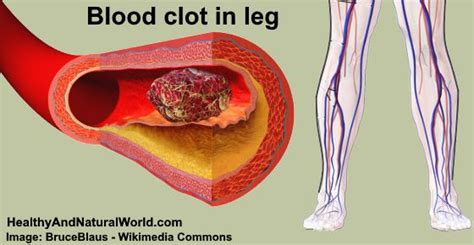 Blood Clot in Leg: Signs, Symptoms, and Treatment (Including Pictures)