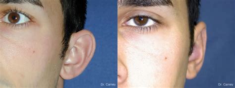 Otoplasty And Earlobe Repair Before After Gallery Patient 1