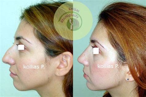 Rhinoplasty Nasal Tip Ptosis 041 Π Κόλλιας