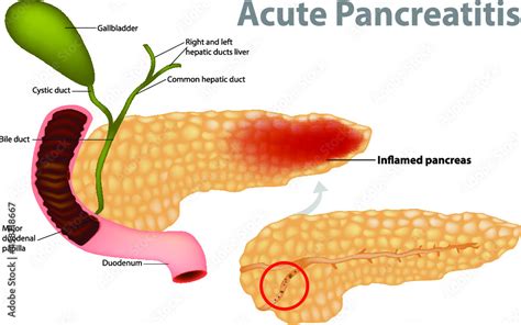 Acute Pancreatitis caused by gallstone. Gallstones block the flow of ...