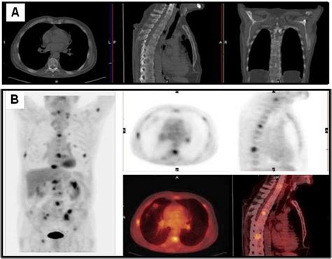 Patient With A Nsclc In The Left Superior Lobe Treated Three Years Download Scientific Diagram