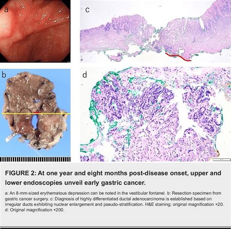 Figure 2 From Anti MDA5 Antibody Positive Clinically Amyopathic