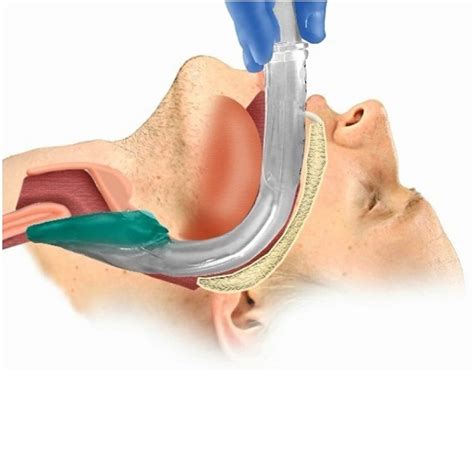 Non Inflatable Laryngeal Mask Airway Riomed Medical Supplies