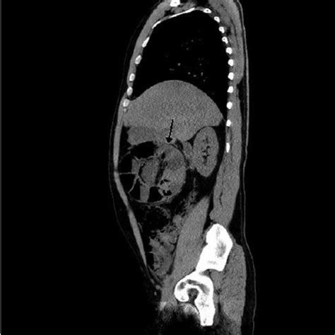 Sagittal View Of Preoperative Abdominal Ct Scan Demonstrating