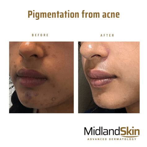 Acne Pigmentation Treatment In Birmingham By Dermatologists