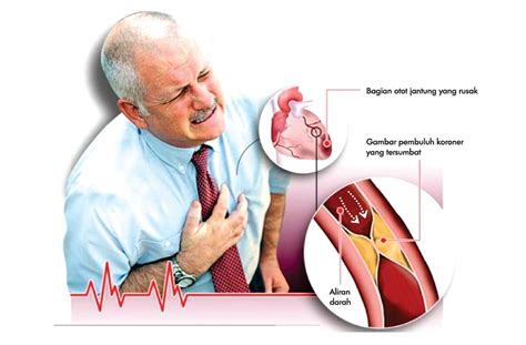 Terkena Serangan Jantung Pertama Ini Ciri Cirinya
