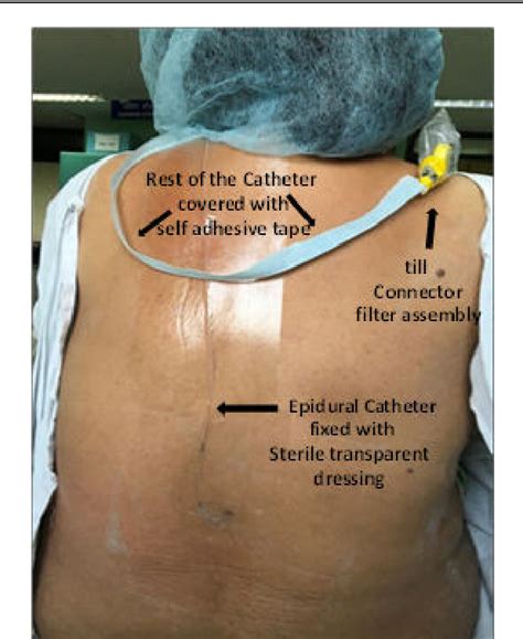 Epidural Catheter Fixation And Care A Novel Technique Semantic Scholar