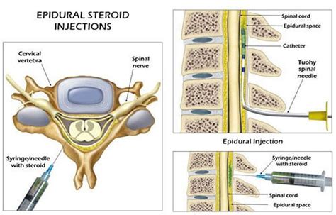 Sciatica Do Epidurals Help — Sobel Spine And Sports