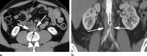 Abdominal Aortic Stenosis Due To Retroperitoneal Fibrosis A Download Scientific Diagram