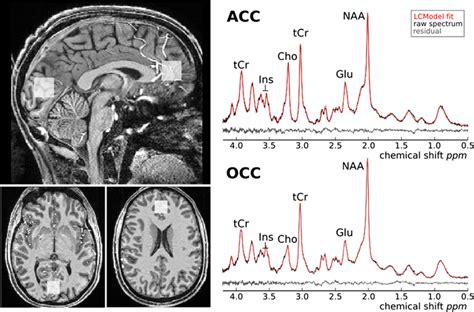 Voxel Placement And Representative Spectra From The Anterior Cingulate