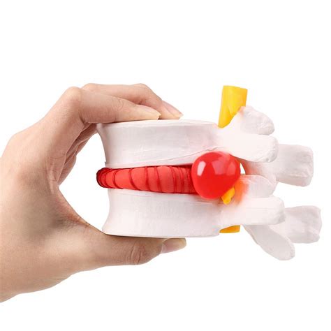 Anatomical Lumbar Disc Herniation Demonstration Model For Human Spine