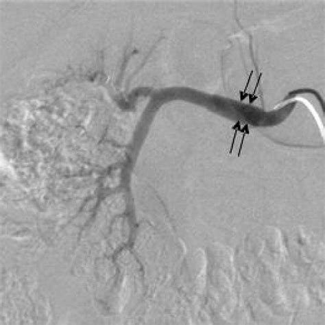 Right Renal Arteriogram Shows Diffuse Fusiform Dilation Of Mid Segment Download Scientific