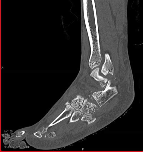 Comminuted Fracture Ankle With Fractures Calcaneus And Talus Trauma