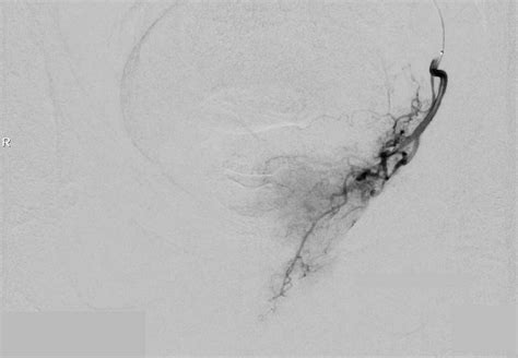 Radiologie Interventionnelle Rouen