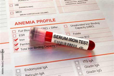 Blood Sample For Analysis Of Serum Iron Test In Laboratory Blood Tube