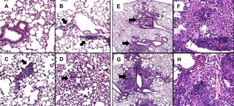 Smokers Lung Histology