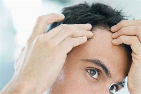 7 Early Signs Of Balding Causes And Next Steps Bald And Beards