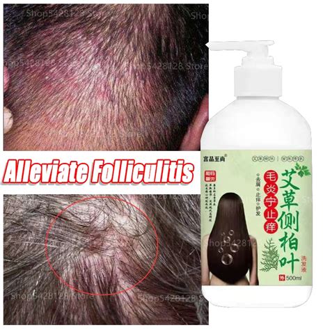 Mild Folliculitis Scalp Treatment