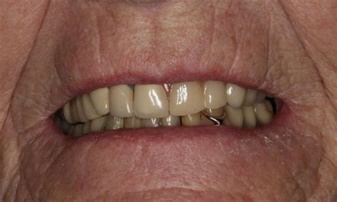 Dentist Results From D Printed Removable Partial Denture