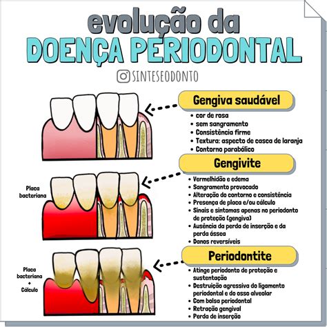 Periodontia Odontologia Resumo Odontologia Gengivite Anatomia Dental