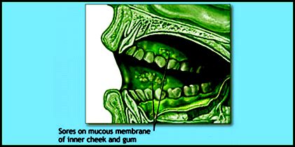 Understanding Mouth Cancer: Causes, Symptoms, Detection, and Treatment