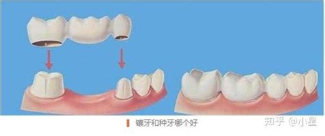 北京 上海 成都全口种植牙多少钱？ 镶牙和种牙哪个好？ 知乎