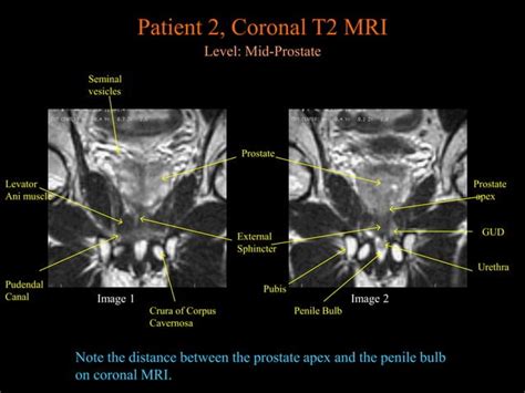 Prostate Mri Anatomy From University Of Michigan Ppt