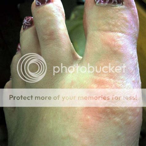 Dyshidrotic Eczema On Feet Pictures Photos