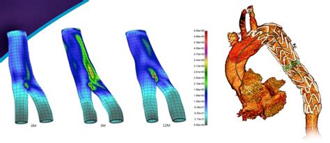 Blood Flow Analysis Cfd Cardiomed Technology Consultants